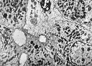 M,18y. | dilated primary bile ducts - blocked bile transport M,18y. | dilated primary bile ducts - blocked bile transport